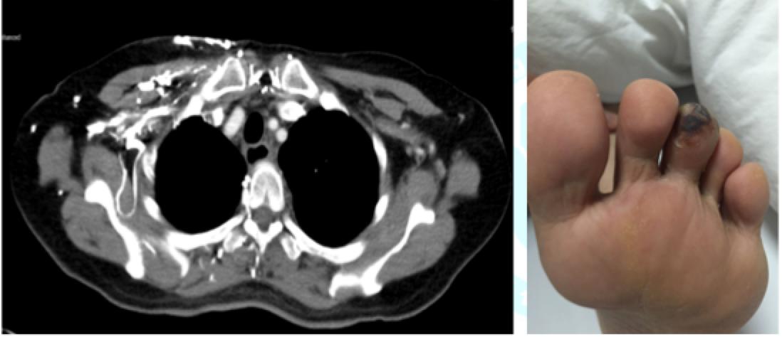 egfr突变和ros1突变同时存在,egfr突变的肺癌1a期
