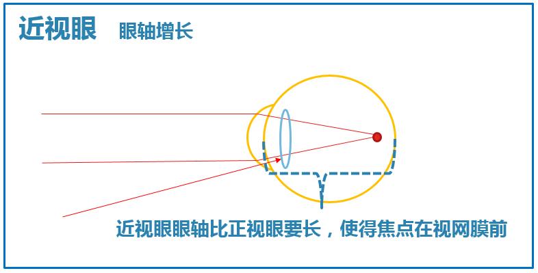 50岁近视一百度严重么,近视两眼会无神吗