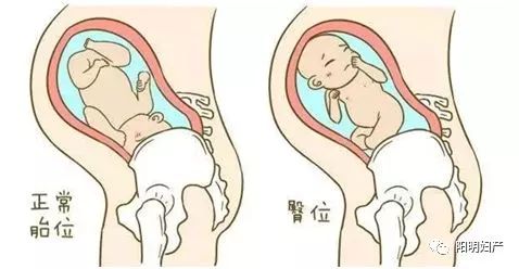 预产期要到了宝宝jio朝外?产科这套“乾坤大挪移”帮宝宝转身!