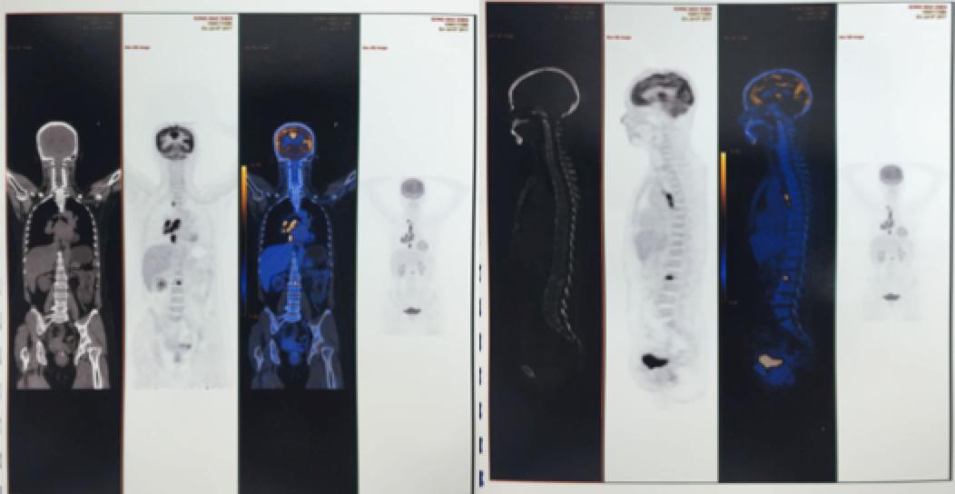 egfr突变和ros1突变同时存在,egfr突变的肺癌1a期