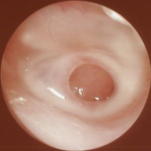 掏耳屎的正确方法,怎么正确掏耳屎