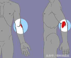 网球肘小臂疼痛难忍,如何缓解网球肘胳膊疼痛