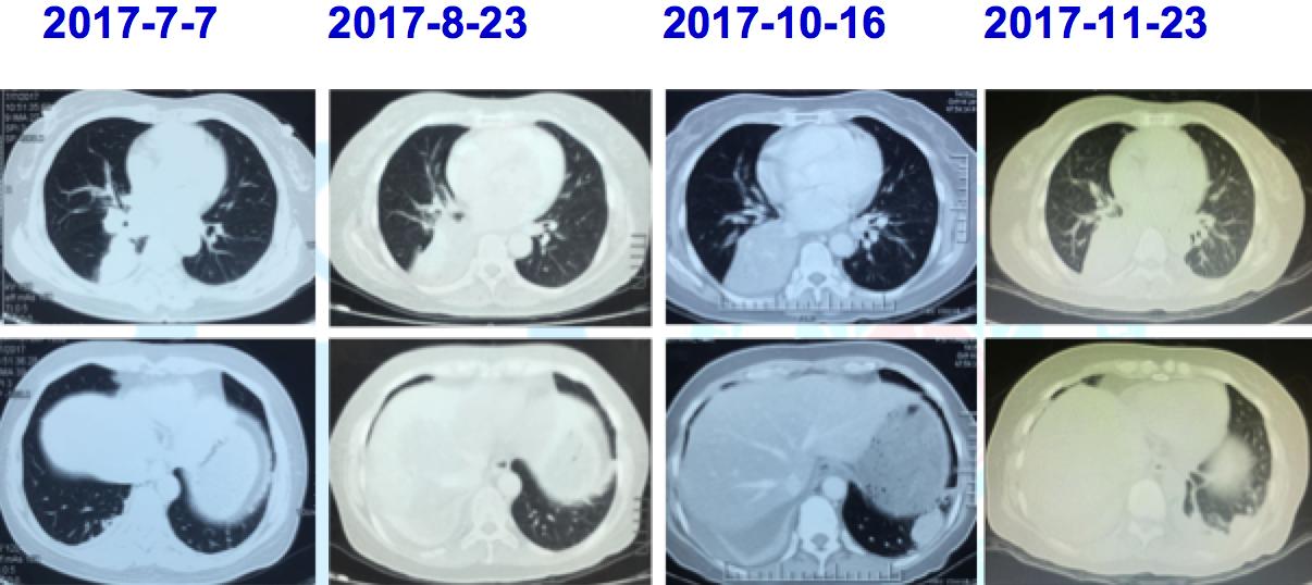 egfr突变和ros1突变同时存在,egfr突变的肺癌1a期