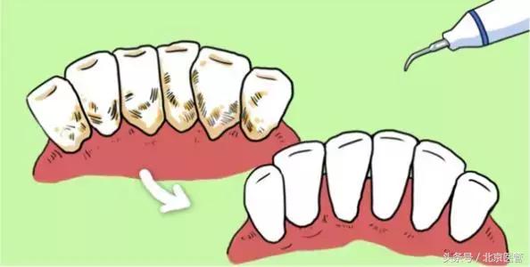 牙龈肿痛刷牙时出血啥原因,牙龈肿痛刷牙会出血吗