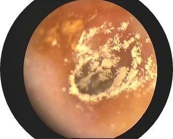 掏耳屎的正确方法,怎么正确掏耳屎