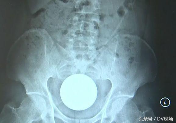 东莞男子肛门塞进直径8厘米玻璃球，紧急就医！