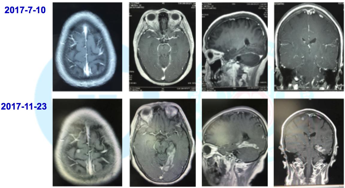 egfr突变和ros1突变同时存在,egfr突变的肺癌1a期