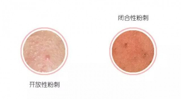 闭口肤质怎么改善,长闭口的正确消除方法