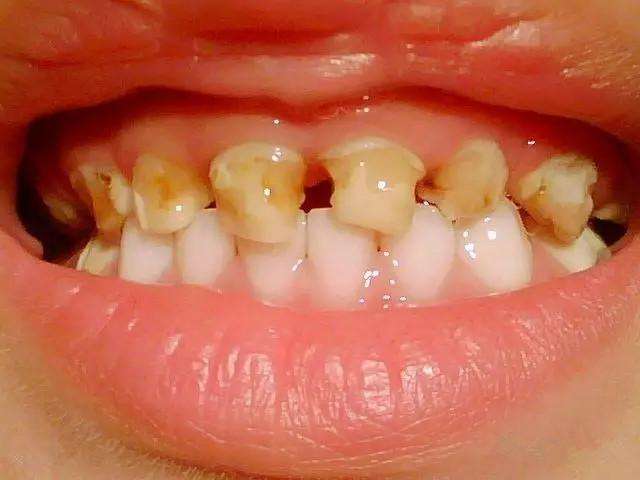 宝宝牙齿发黑是什么原因引起的,宝宝牙齿有点发黑是怎么回事