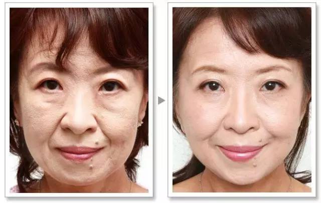 线雕是埋在哪个层次的,线雕埋进去能取出来吗