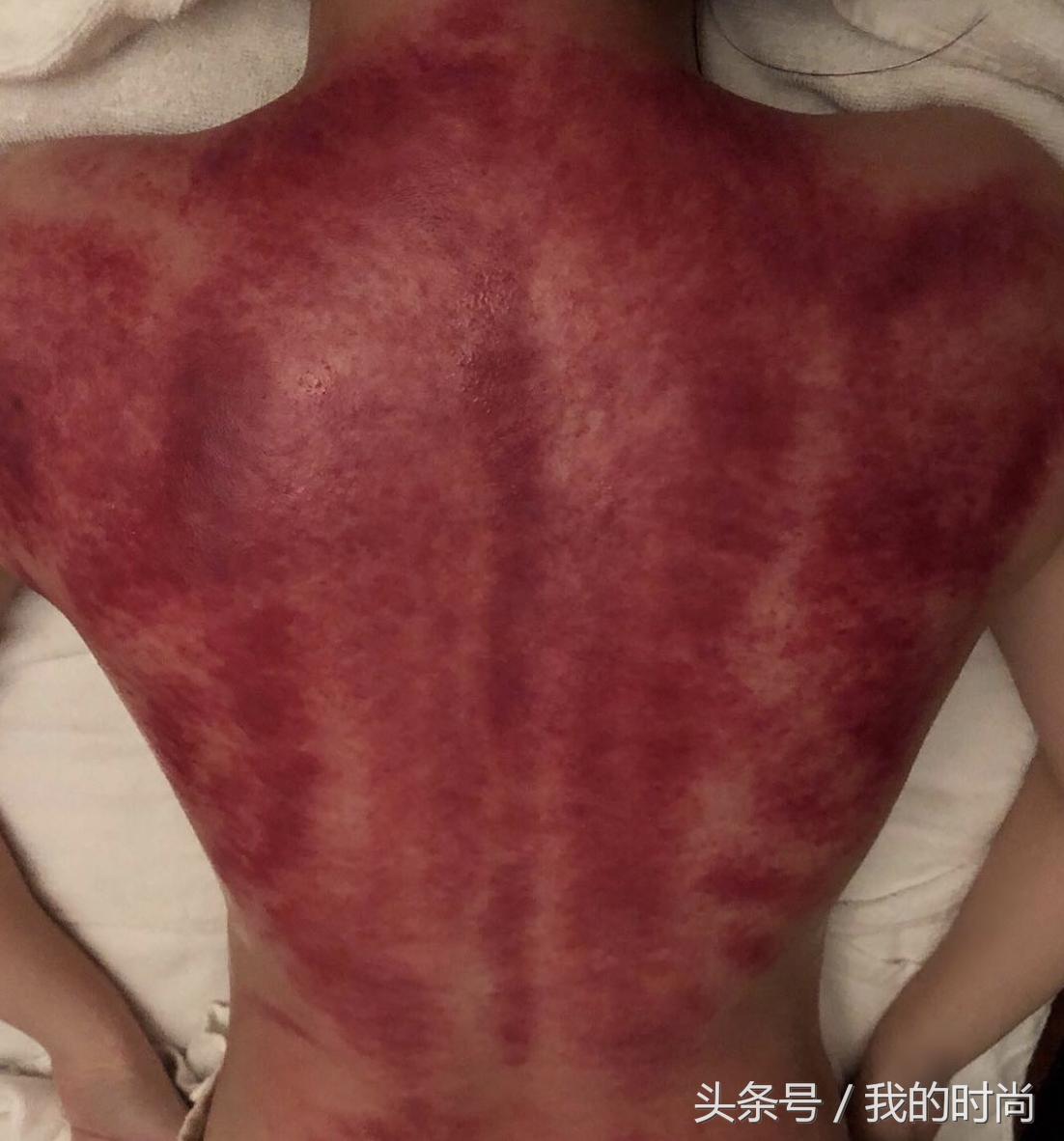 看见觉得疼！阿娇刮痧晒“血背照”：整块皮好像给撕掉了一样