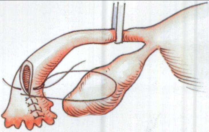 哪些人比较容易患上宫外孕,哪些人更容易出现宫外孕