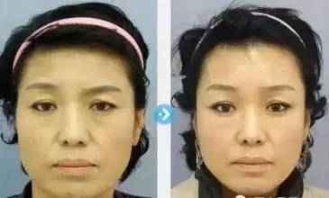 线雕是埋在哪个层次的,线雕埋进去能取出来吗