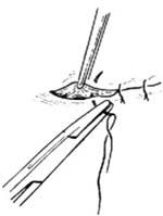 皮脂腺囊肿切除术多少钱,皮脂腺囊肿切除术