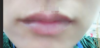 嘴角干燥脱皮性唇炎,干燥性的唇炎是慢性唇炎吗