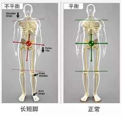 高低肩长短腿矫正视频,高低肩腿长短不一纠正训练动作