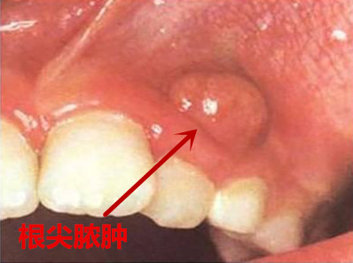 小孩牙疼一定不要轻易去治疗,家长们不可大意