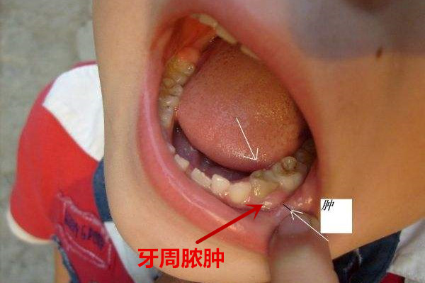 小孩牙疼一定不要轻易去治疗,家长们不可大意