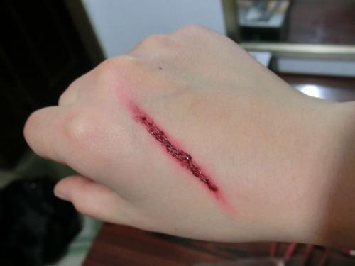 伤口破损艾滋病,伤口感染艾滋的条件