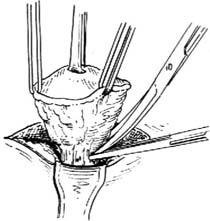 皮脂腺囊肿切除术多少钱,皮脂腺囊肿切除术