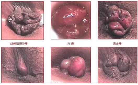痔疮便血喷射怎么办,痔疮胀得很咋办