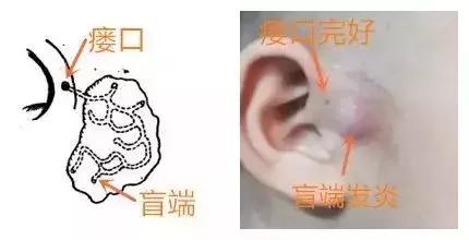 耳朵上方有个小孔流脓是怎么回事,耳朵的富贵洞能治好吗