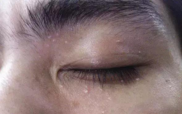 不用针挑刺,不用针挑刺还有什么办法能挑