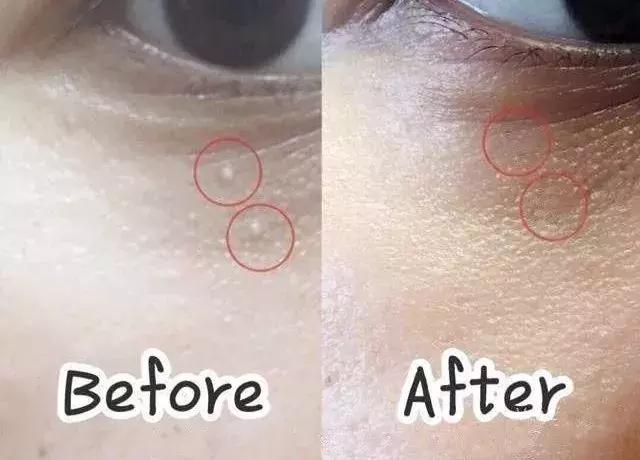 不用针挑刺,不用针挑刺还有什么办法能挑