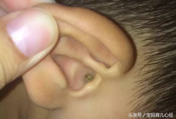 一岁多的宝宝掏耳屎会聋吗,掏耳屎会影响孩子智力吗