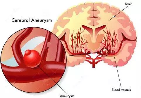 大学生做飞秒手术后濒临死亡,大学生救死扶伤后死亡