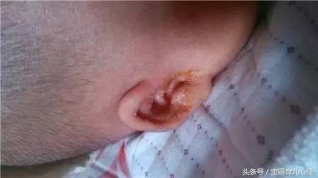 一岁多的宝宝掏耳屎会聋吗,掏耳屎会影响孩子智力吗