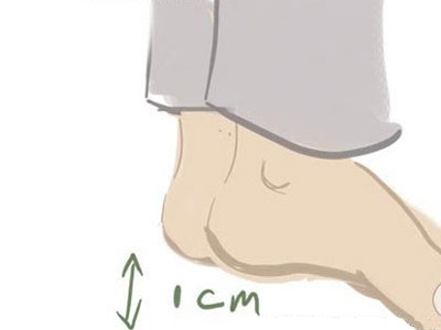 臀纹不对称,臀围不对称原因