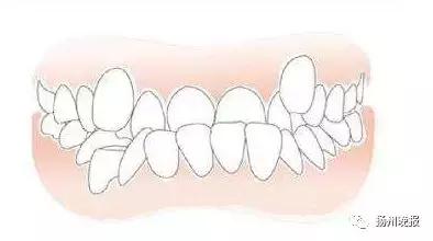 长出两排牙齿,6岁女童下排有11颗牙齿