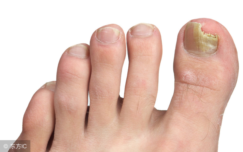 较严重灰指甲医院治疗,最难治的灰指甲