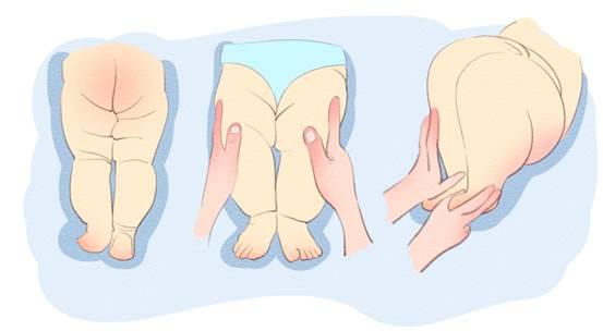 臀纹不对称,臀围不对称原因