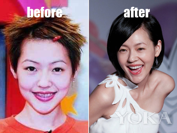 大变脸原来整牙才是高颜值,女星整牙都是越整越美