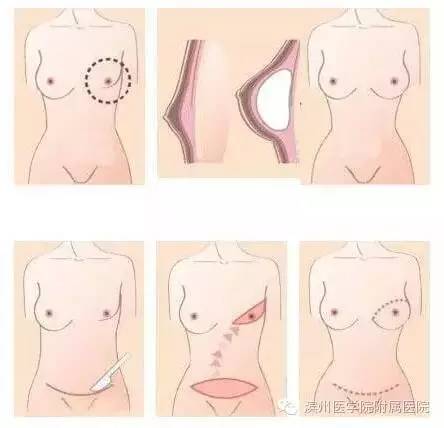 健康养护乳房,健康乳房有什么表现