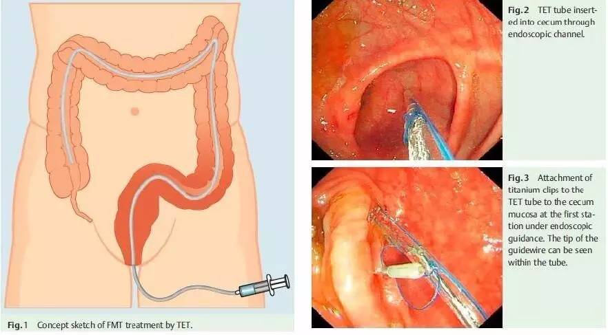 粪菌移植的讲解视频,粪菌移植最新方法