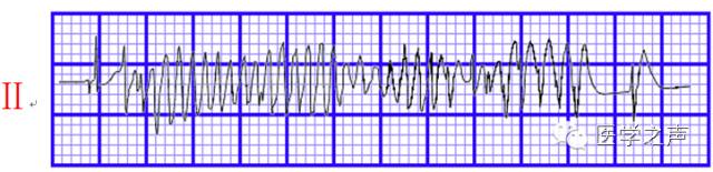 室颤和尖端扭转型室速心电图区别,心电图的完整讲座视频
