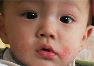湿疹治疗过程中需要注意什么,宝宝湿疹大作战图文