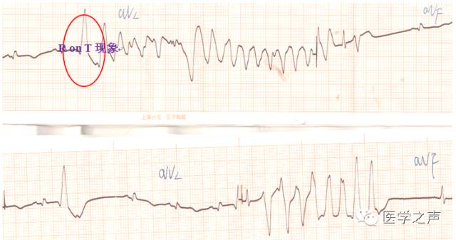 室颤和尖端扭转型室速心电图区别,心电图的完整讲座视频