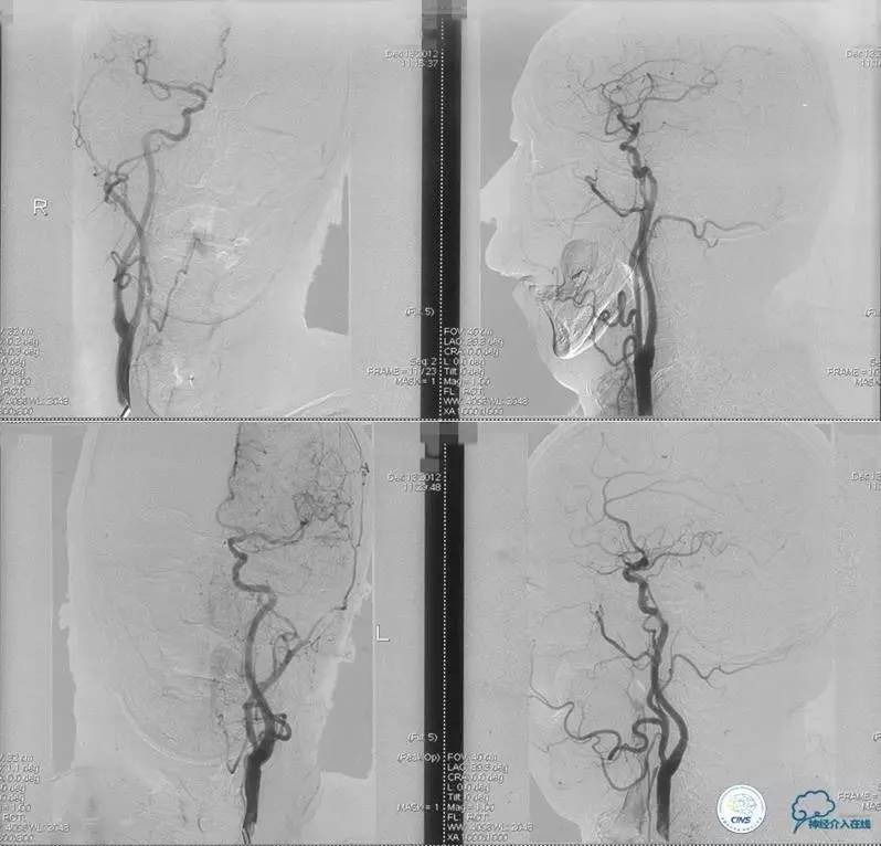 椎基底动脉闭塞严重吗怎么治疗,椎基底动脉局部闭塞微创手术