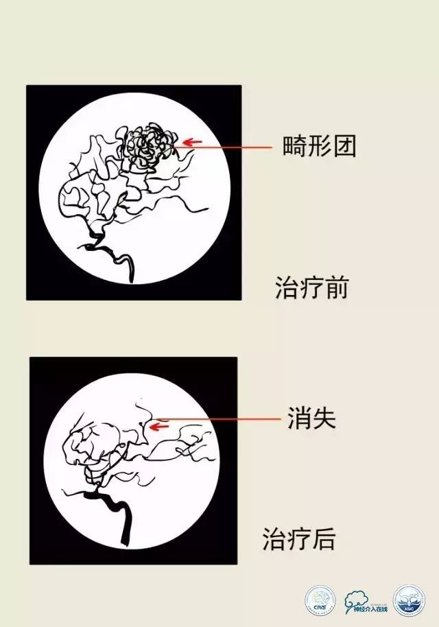 熊猫医生阿缪：脑动静脉畸形怎么破