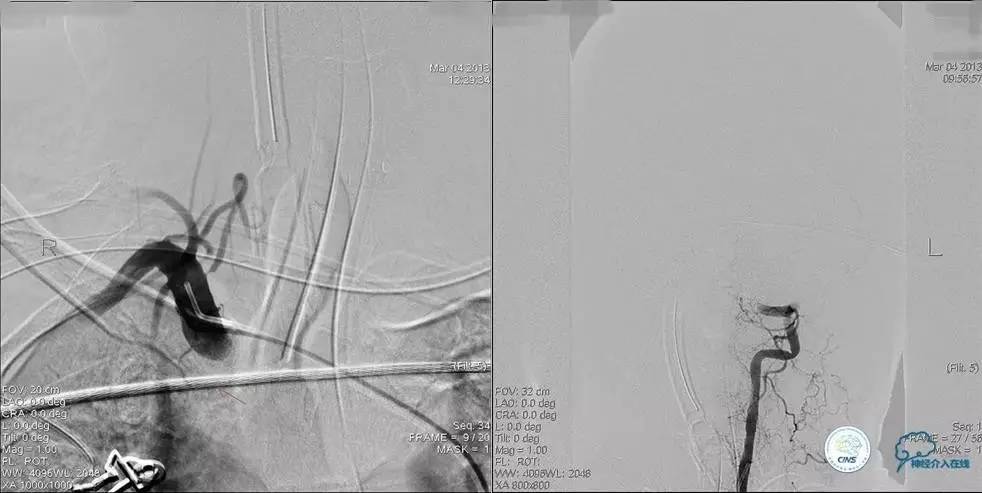 椎基底动脉闭塞严重吗怎么治疗,椎基底动脉局部闭塞微创手术