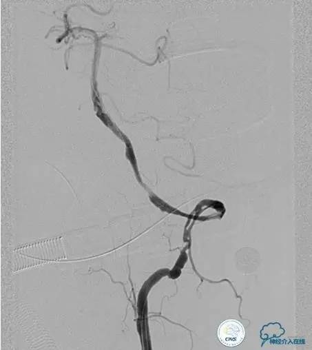 椎基底动脉闭塞严重吗怎么治疗,椎基底动脉局部闭塞微创手术