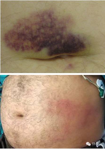 2021版急性胰腺炎诊断标准,学生急性胰腺炎