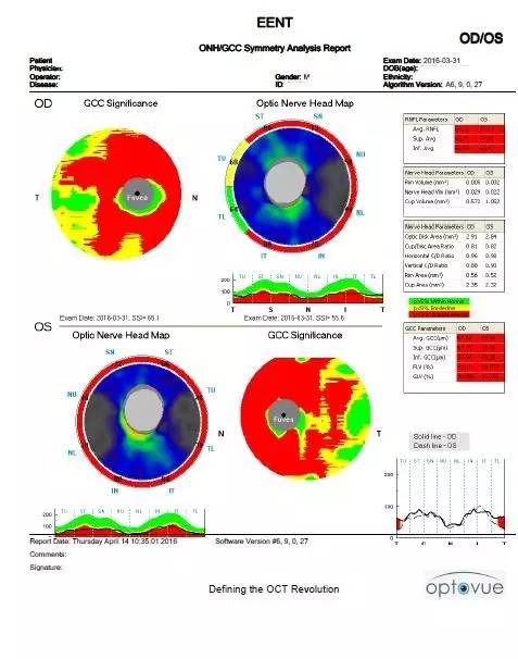 苏世独”例“晚期原发性开角型青光眼1例