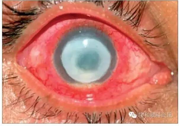 文摘速递棘阿米巴角膜炎：糖皮质激素禁区？