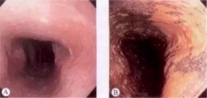 食管癌早期筛查手段,早期食管癌内镜的切除方式有哪些