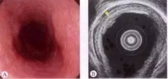 食管癌早期筛查手段,早期食管癌内镜的切除方式有哪些